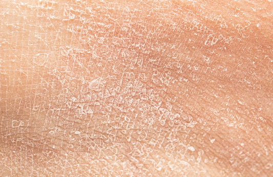 Peau-sèche-terne-sensible-quelles-carences-en-vitamines-ou-minéraux Hectyl